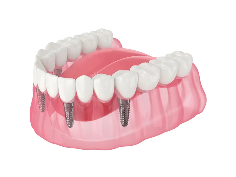 Fixed full-arch bridge anchored to four dental implants — All-on-4 treatment in Melbourne