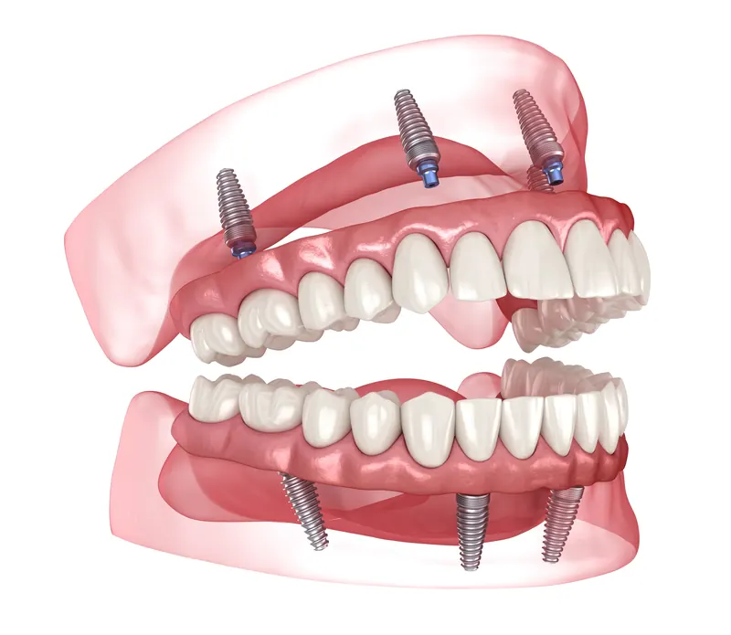 Dental model showing a complete full mouth rehabilitation plan