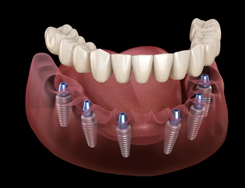 Overdenture clipping securely onto dental implants in the jaw