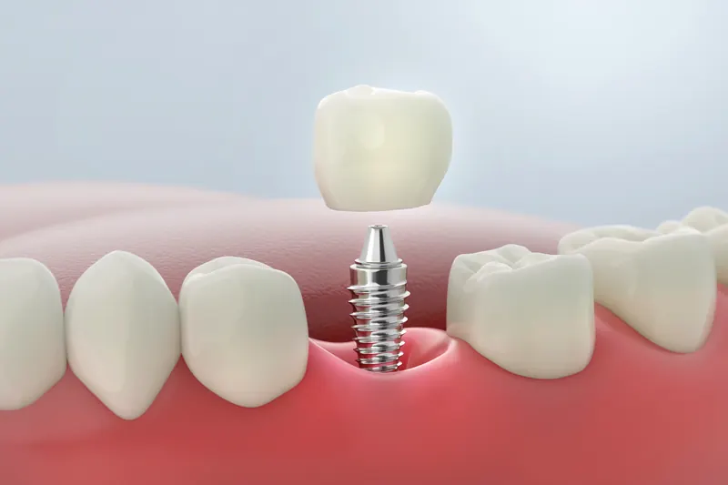 Titanium dental implant and porcelain crown replacing one missing tooth